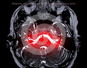 MRI Brain scan  with  the internal auditory canal (IAC) axial view photo