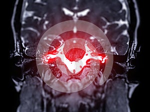 MRI Brain scan  with  the internal auditory canal (IAC) Coronal view photo