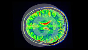 MRI brain scan, magnetic resonance image. CT scan of human brain in dynamic.