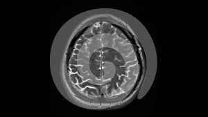 MRI brain scan, magnetic resonance image. CT scan of human brain in dynamic.