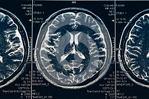 MRI brain scan or x-ray neurology human head skull tomography test