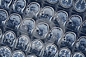 MRI brain scan or x-ray neurology human head skull tomography test