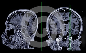 MRI  brain scan Sagittal and coronal view with reference line for detect  Brain  diseases sush as stroke disease, Brain tumors and