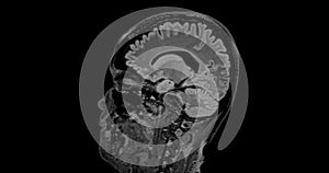 MRI  brain scan  sagittal flair for detect  Brain  diseases sush as stroke disease, Brain tumors and Infections