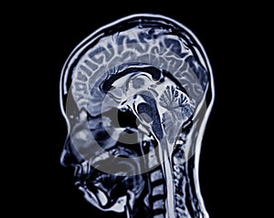 MRI  brain scan  sagittal plane for detect  Brain  diseases sush as stroke disease, Brain tumors and Infections