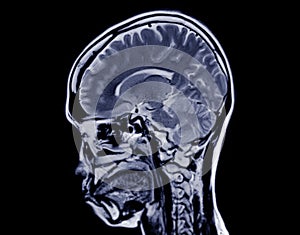 MRI  brain scan  sagittal plane for detect  Brain  diseases sush as stroke disease, Brain tumors and Infections