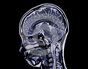 MRI  brain scan  sagittal plane for detect  Brain  diseases sush as stroke disease, Brain tumors and Infections