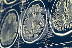 MRI brain scan or x-ray neurology human head skull tomography test photo