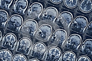 Mozog skenovať alebo neurológia človek hlava lebka tomografia 