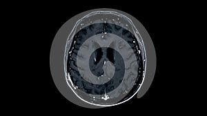 MRI brain scans axial view offer valuable insights into brain an