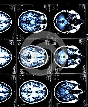 MRI brain scans of a patient with Multiple Sclerosis photo