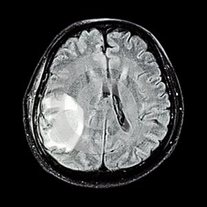 MRI brain : show brain tumor