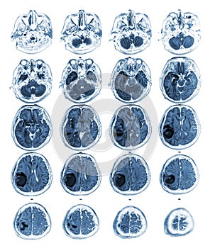 MRI brain show Brain tumor at right parietal lobe