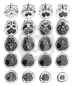 MRI brain show Brain tumor at right parietal lobe