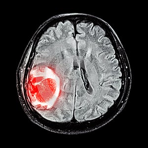 MRI brain : show brain tumor at right parietal lobe of cerebrum photo