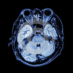 MRI brain : show lower part of brain