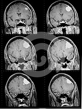 Mri of brain showing brain tumor