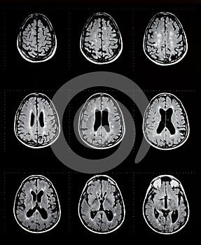 Mri of brain showing multiple sclerosis photo