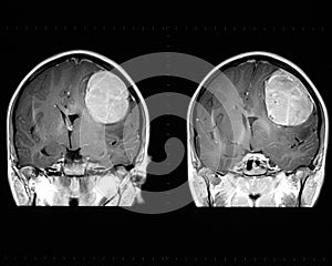 Mri of the brain showing tumor photo