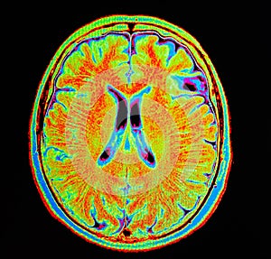 Mri brain stroke