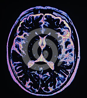 Mri brain stroke photo