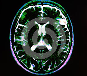 Mri brain stroke photo