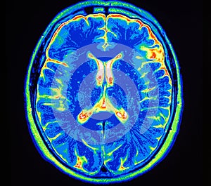 Mri brain stroke photo