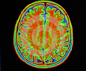 Mri brain stroke photo