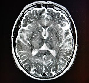 Mri brain stroke photo
