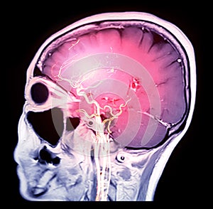 MRI brain T1 sagittal plane with 3D rendering CTA Brain image.