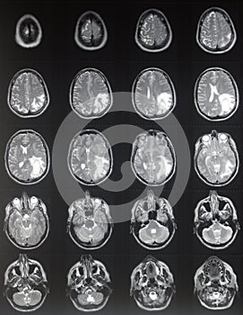 MRI brain tumor