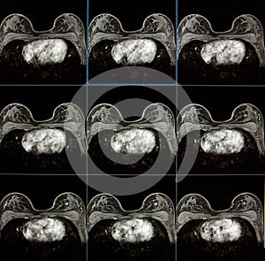 MRI of breast - breast cancer