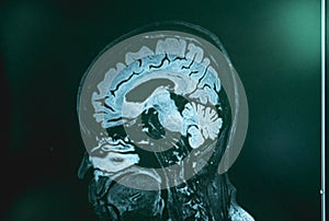 MRI brian of Dementia patient