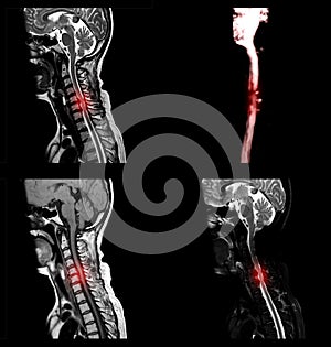 MRI C-spine or magnetic resonance image of cervical spine.