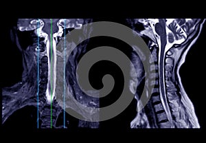 MRI of  C-spine or magnetic resonance image of cervical spine sagittal view  for diagnosis spondylosis causing cervical