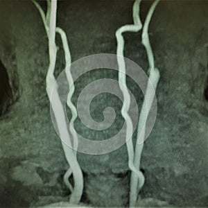 Mri carotid artery complete occlusion