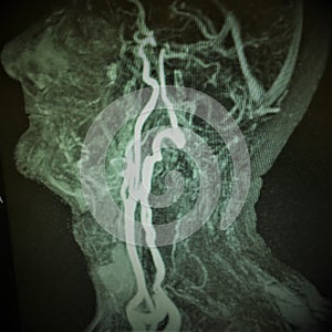 Mri carotid artery complete occlusion