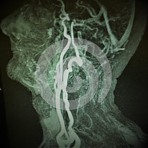 Mri carotid artery complete occlusion photo