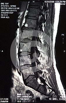 MRI CAT Scan Spine Detail Xray