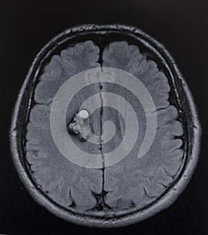 Mri cavernoma ganglia brain exam