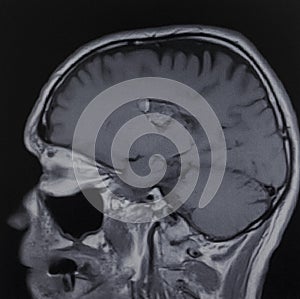 Mri cavernoma ganglia brain exam photo