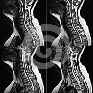 MRI of cervical spine, disc herniation photo