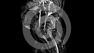 Mri of cervical spine history: a 57-year-old male, presented with history of vehicle accident Total causing spinal cord injury and
