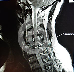 Mri of cervical spine stenosis