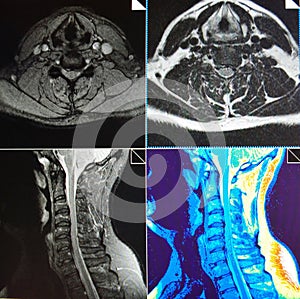 Mri of cervical spine stenosis