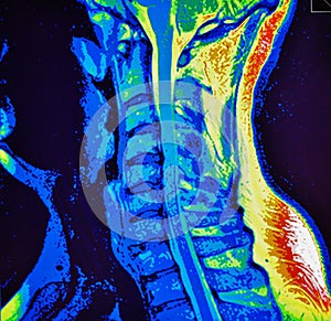 Mri of cervical spine stenosis