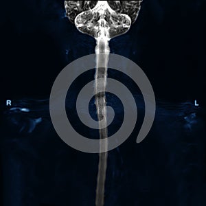 MRI of cervical spine use technique myelogram.