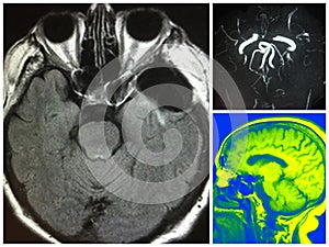 Mri clipping artifact bilateral cerebral aneurysm photo