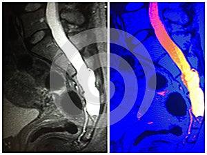 Mri dural ectasia sacrum level neuro collage