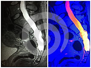 Mri dural ectasia sacrum level neuro collage photo